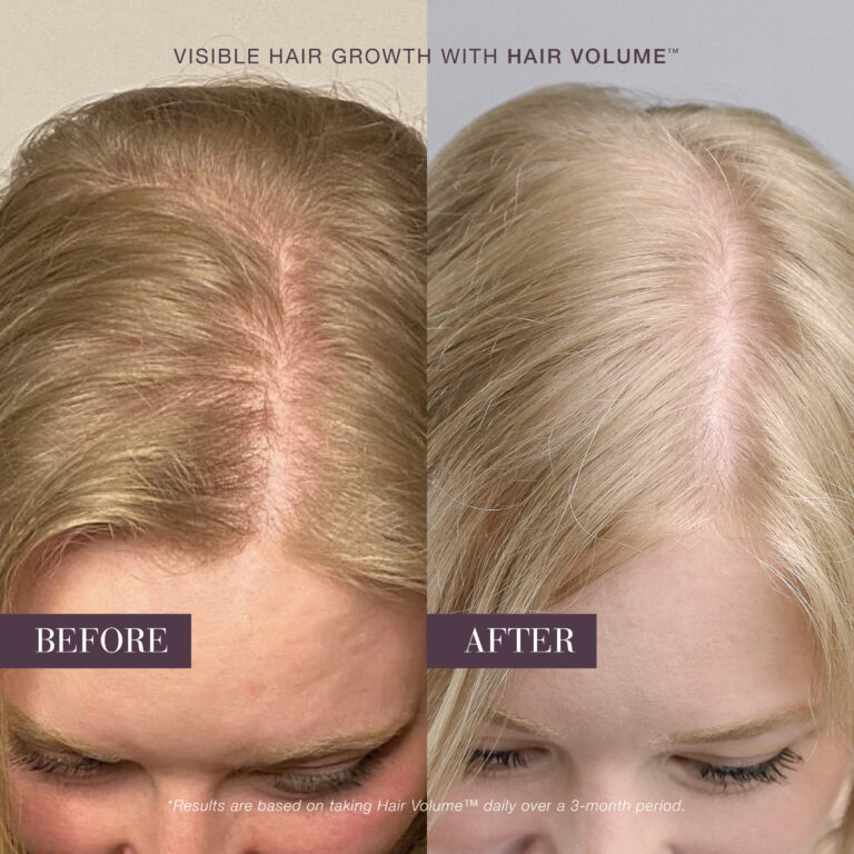 Before-and-after scalp showing fuller hair after using New Nordic Hair Volume™.