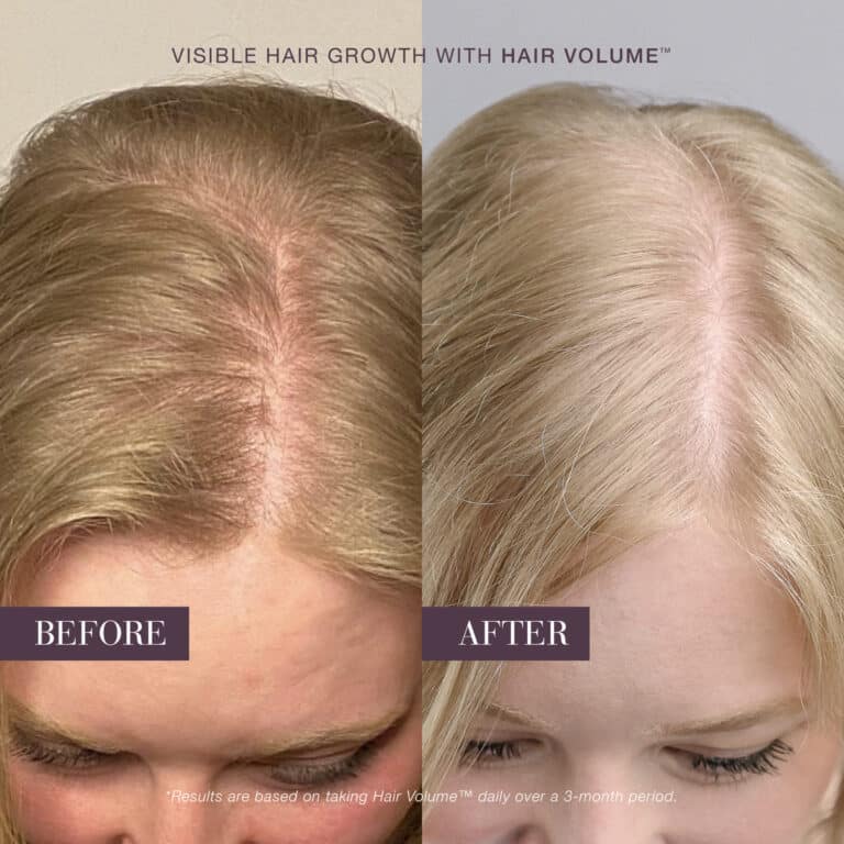 Before-and-after scalp showing fuller hair after using New Nordic Hair Volume™.