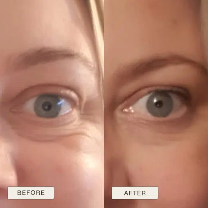 Image cut in half with one half a picture of an eye with wrinkles and the words 'before' and the right side 'after' with less wrinkles