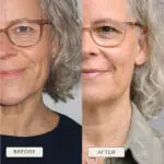 Image cut in half with one half a picture of a woman with wrinkles and the words 'before' and the right side 'after' with less wrinkles