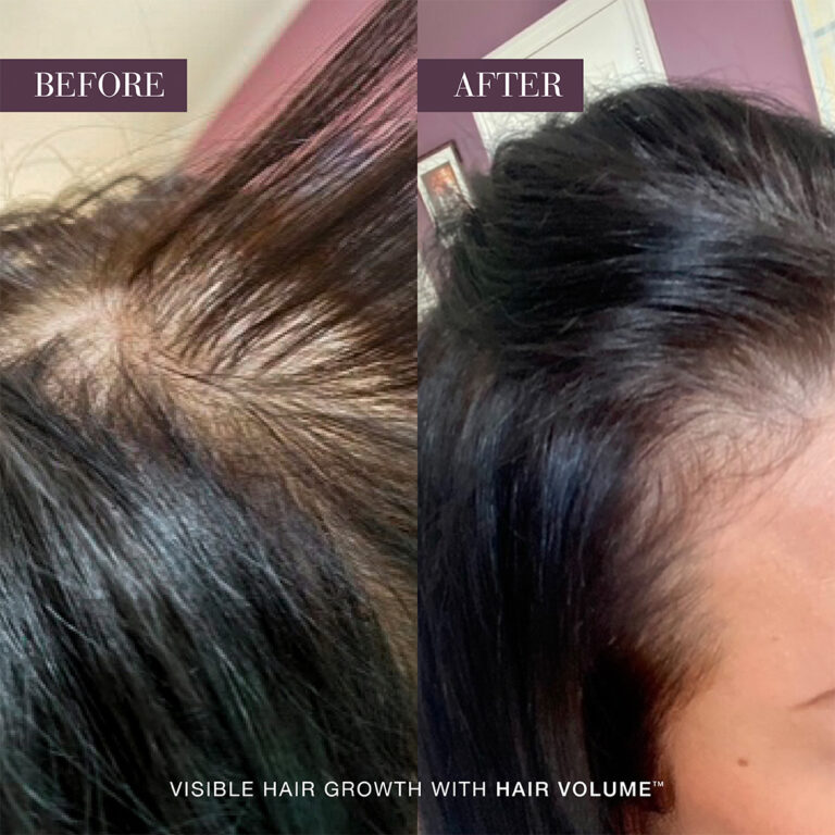 Before-and-after scalp showing fuller hair after using New Nordic Hair Volume™.