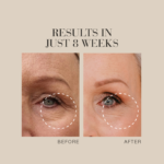 Text Results in just 8 weeks, shown above a before-and-after close-up of a woman’s eye, revealing visibly reduced wrinkles.