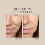 Text Results in just 8 weeks shown above a before-and-after close-up of a woman’s mouth, revealing visibly reduced wrinkles.