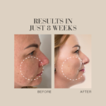 Image with text Results in just 8 weeks followed by before and after images showing visibly clearer skin in the after image.