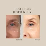 Text Results in just 8 weeks, shown above a before-and-after close-up of a woman’s eye, revealing visibly reduced wrinkles.