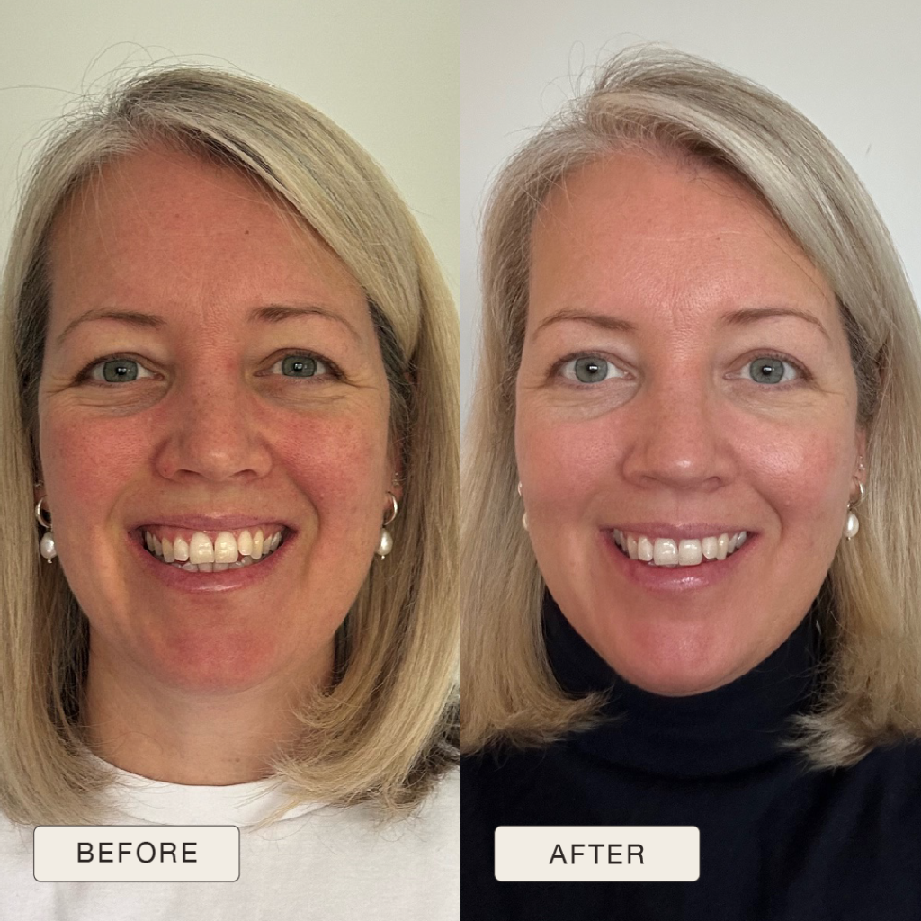 Testimonial Rebecca, Before and after pictures after use of Natural Magic Skin Care range
