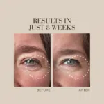 Before and after image showing fewer visible wrinkles in the eye area with text Results in just 8 weeks.